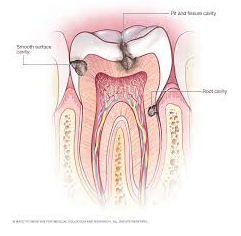 dentitox tooth decay solution